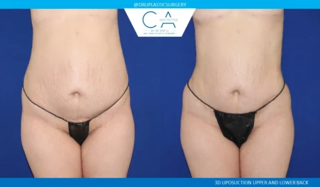 360 Liposuction (Torso) case #5522