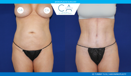 Tummy Tuck case #5240