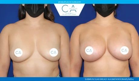 Breast Augmentation case #5226