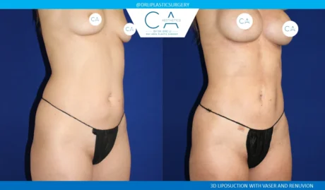 360 Liposuction (Torso) case #5521