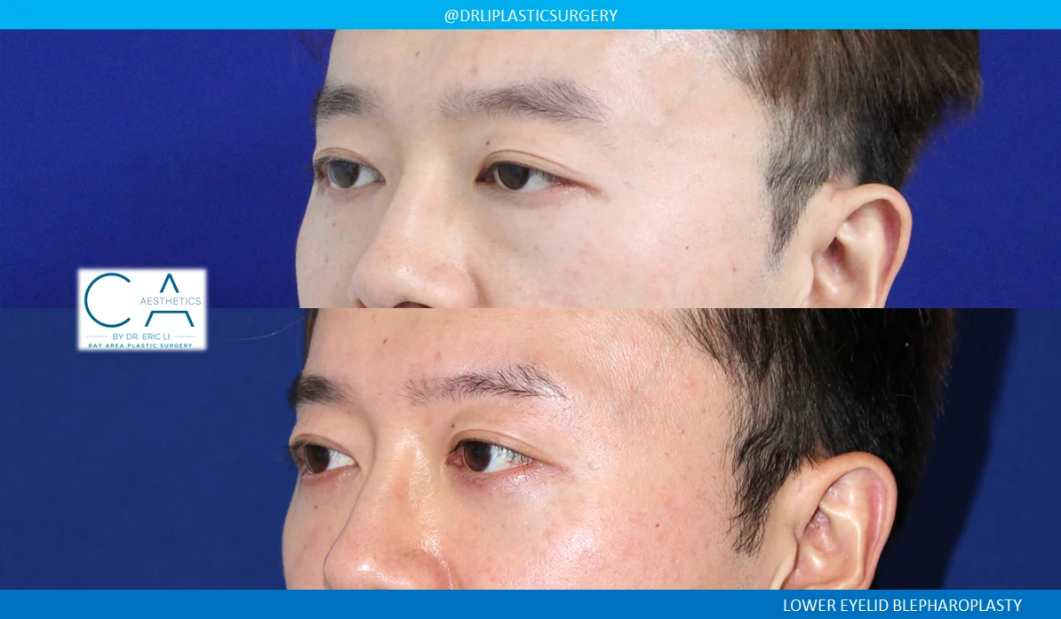 8 – Lower Eyelid Surgery Oblique