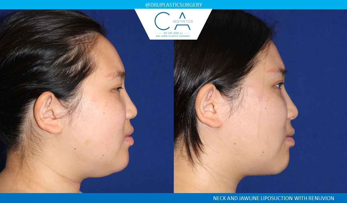 8 – Neck Liposuction with VASER and Renuvion Lateral