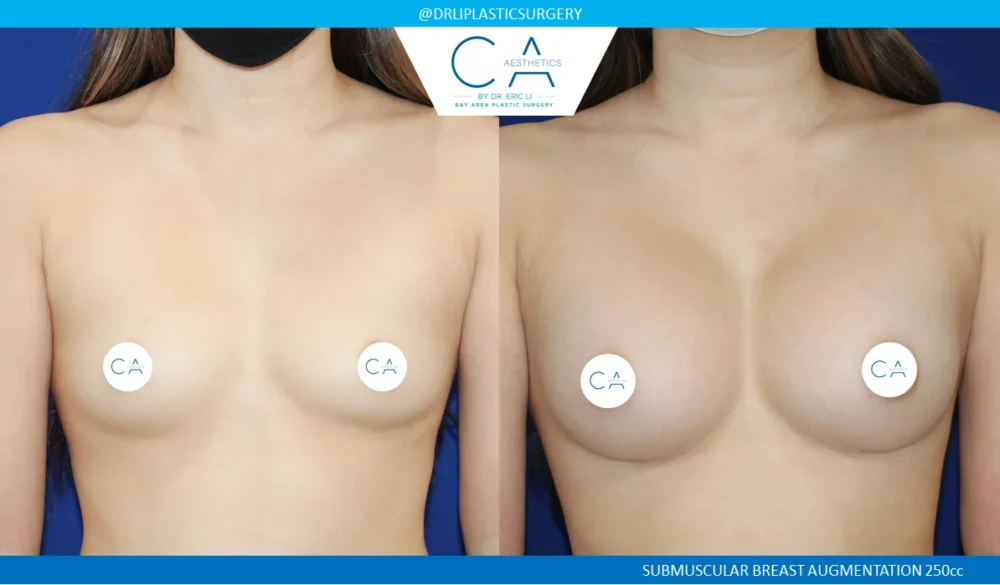 Breast Augmentation case #5225