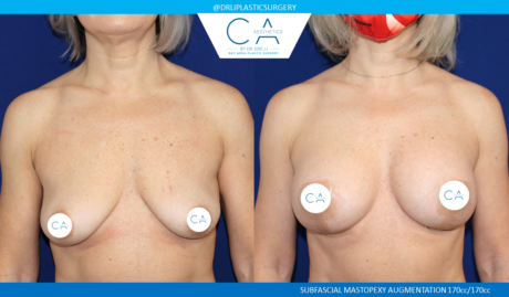 Breast Lift case #5364