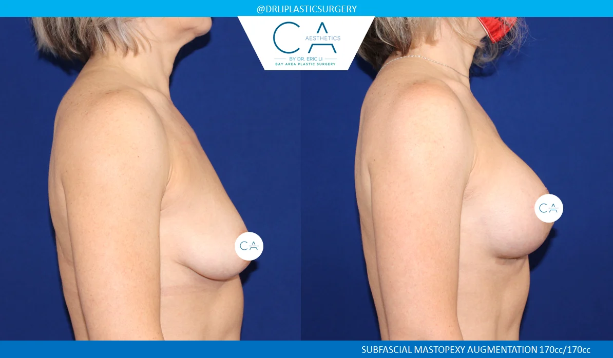 9 – Breast Lift Lateral