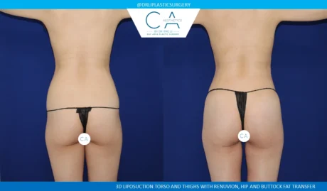 360 Liposuction (Torso) case #5520