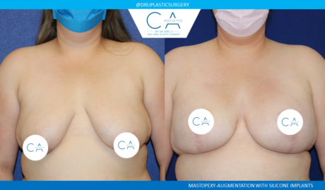 Tuberous Breast Correction case #4834