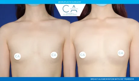 Fat Transfer Breast Augmentation case #4847