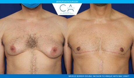 Transmasculine Top Surgery case #4419