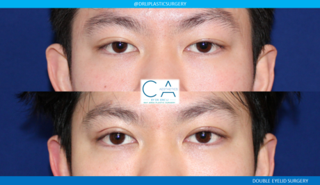 Asian Eyelid case #7777