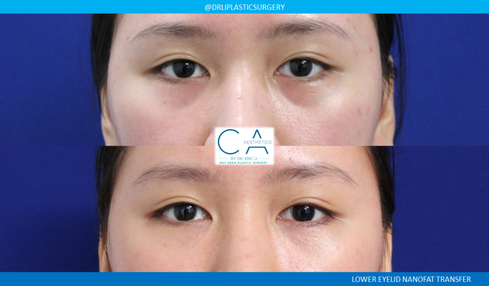 Lower Blepharoplasty (Eyelid Surgery) case #7808