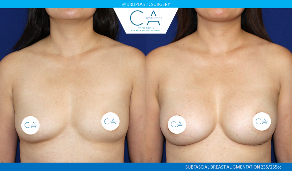 Asian Breast Augmentation case #7773