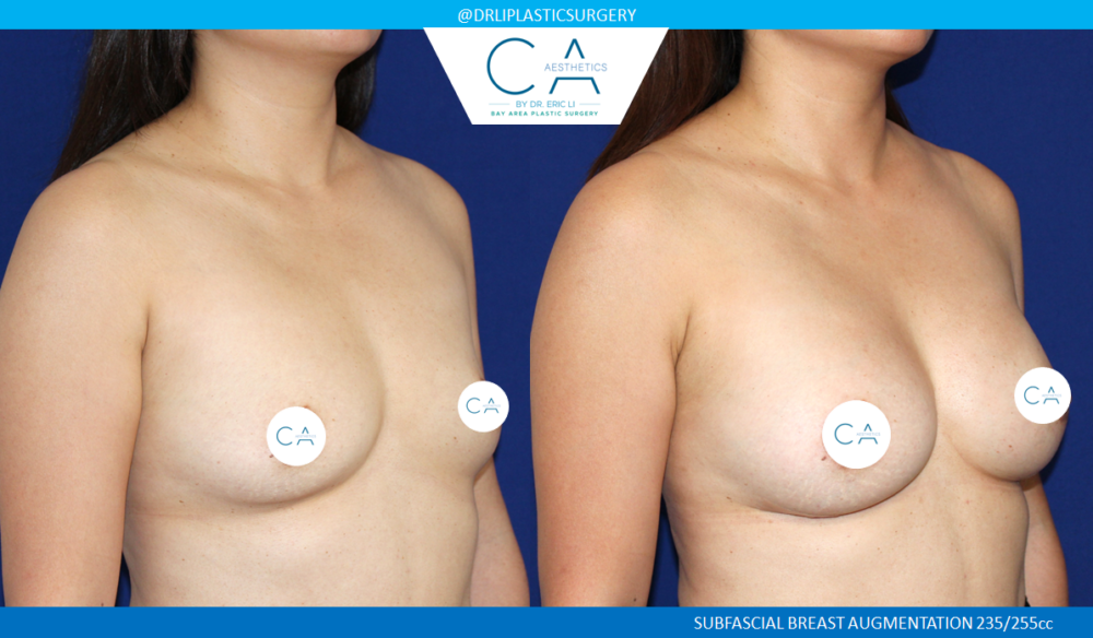 Asian Breast Augmentation case #7773