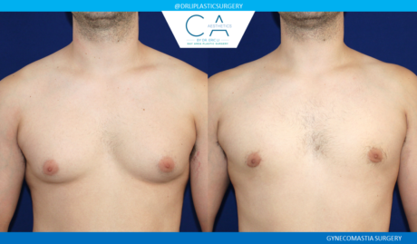 Gynecomastia case #7798