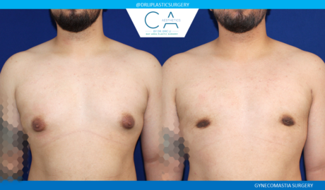 Gynecomastia case #7802