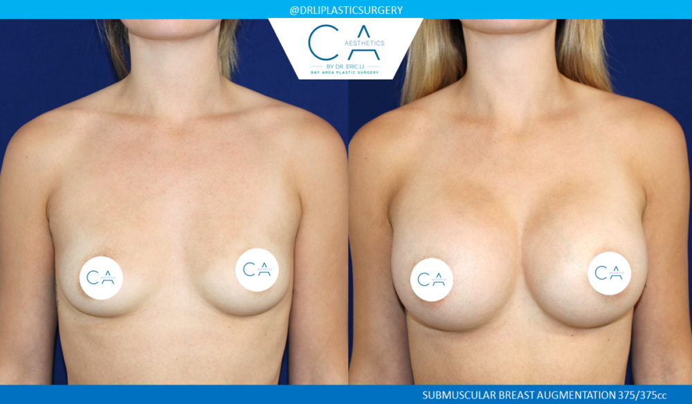 Breast Augmentation case #7779