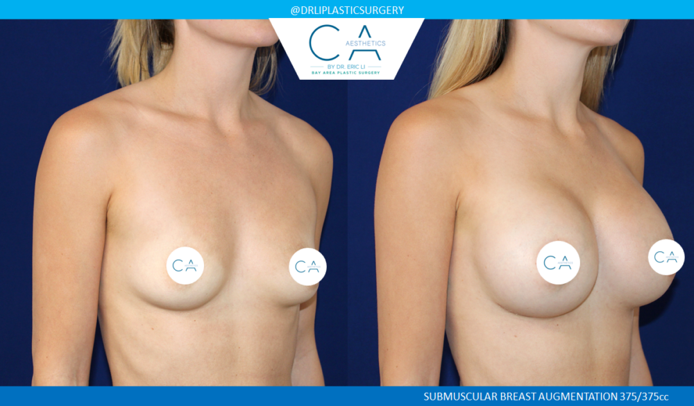 Breast Augmentation case #7779