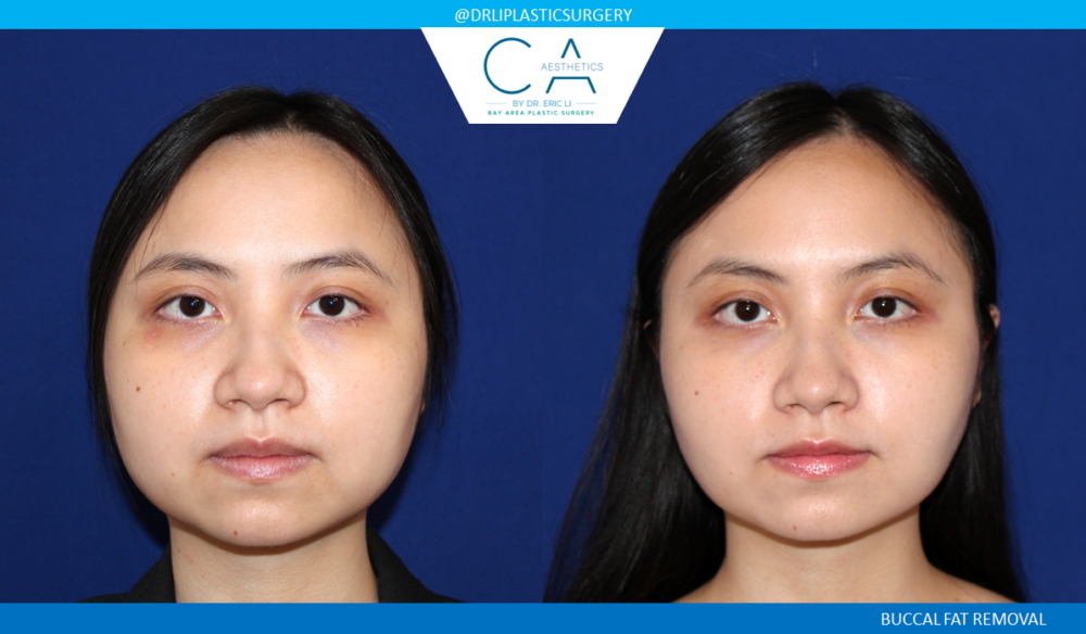 Buccal Fat Removal case #7787