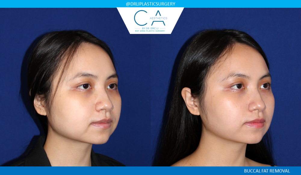 Buccal Fat Removal case #7787