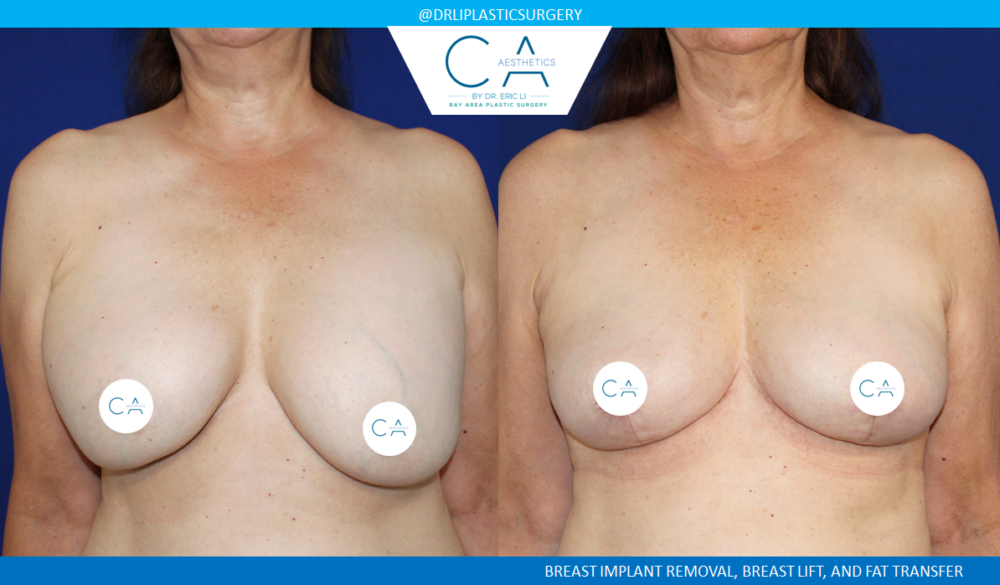 Breast Implant Removal case #7783