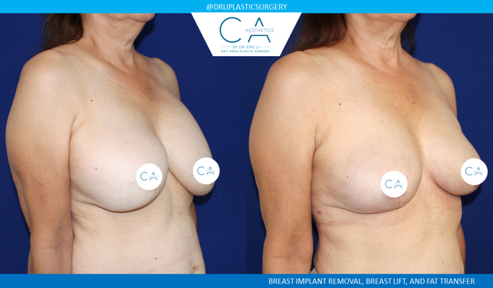 Breast Implant Removal case #7783