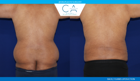 Male Liposuction case #7810