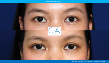 Asian Eyelid case #8405