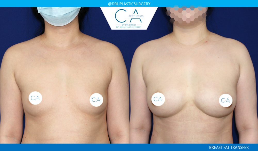 Fat Transfer Breast Augmentation case #8425