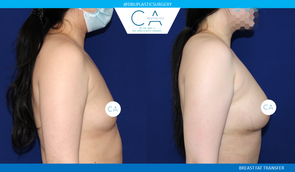 Fat Transfer Breast Augmentation case #8425