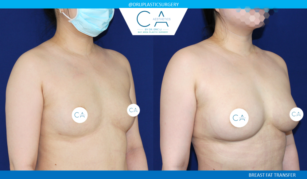 Fat Transfer Breast Augmentation case #8425