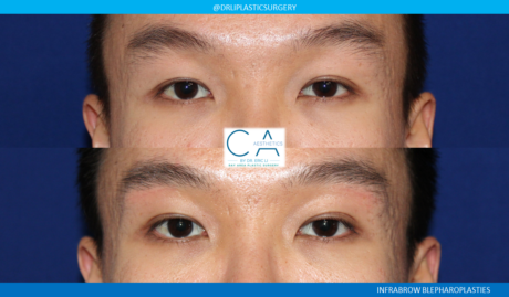 Asian Eyelid case #8382