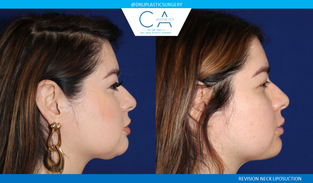 Face & Neck Liposuction case #8465