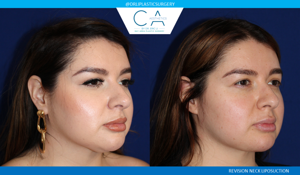 Face & Neck Liposuction case #8465