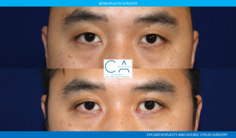 Asian Eyelid case #8369