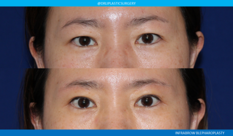 Asian Eyelid case #8363