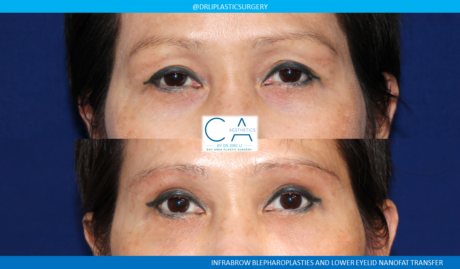 Asian Eyelid case #8361