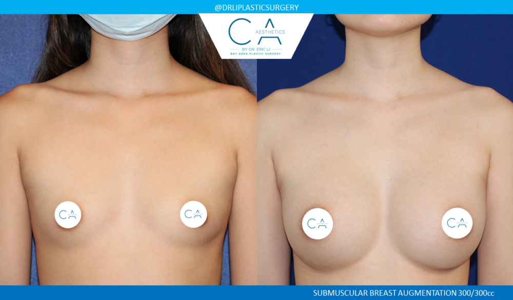 Asian Breast Augmentation case #8350