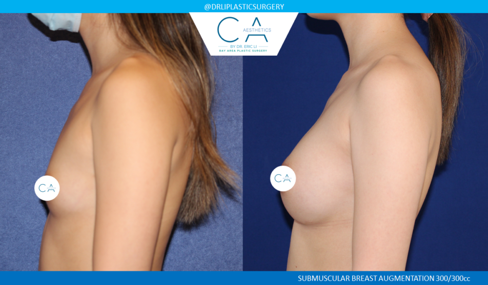 Asian Breast Augmentation case #8350