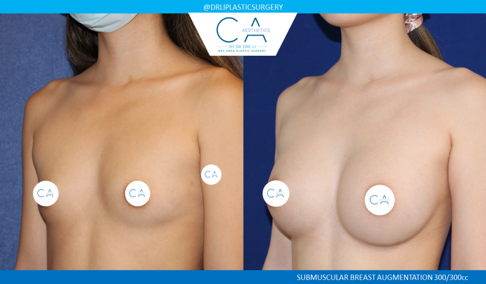 Asian Breast Augmentation case #8350