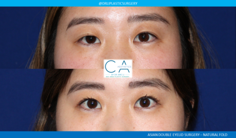 Asian Eyelid case #8403