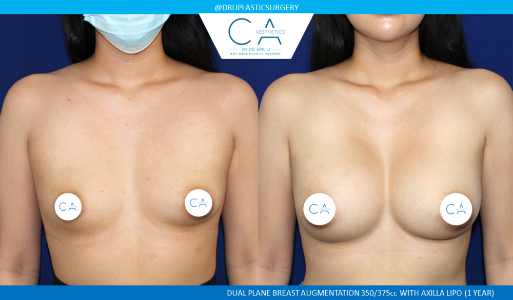 Asian Breast Augmentation case #8354