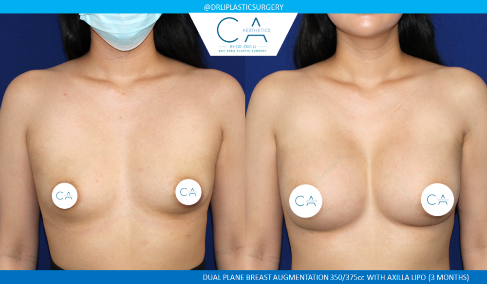 Asian Breast Augmentation case #8354