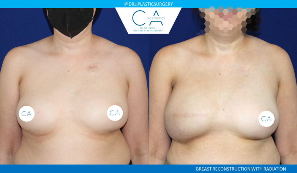 Breast Reconstruction case #8449