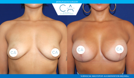 Breast Lift case #8432