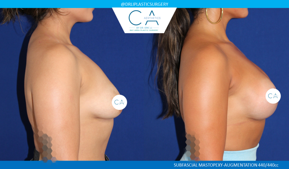 Breast Lift case #8432