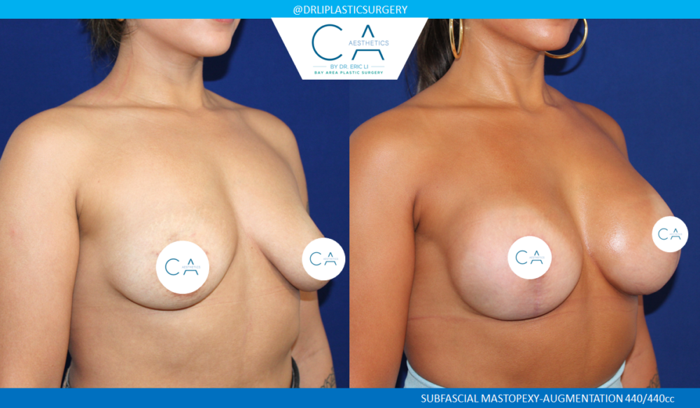 Breast Lift case #8432