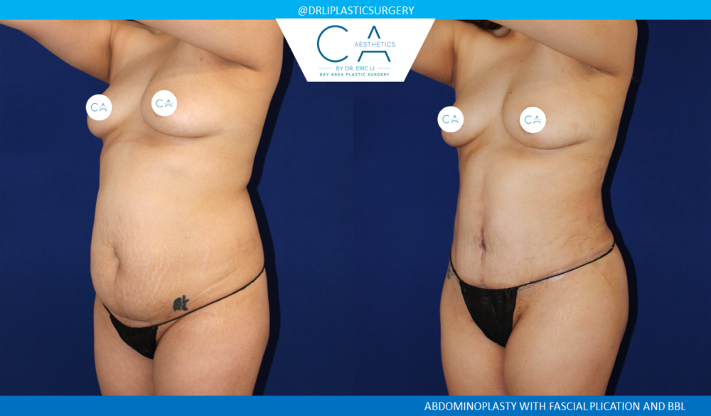 Tummy Tuck case #8492