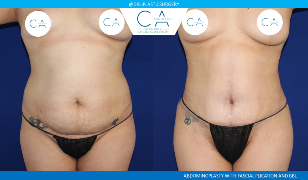 Tummy Tuck case #8492