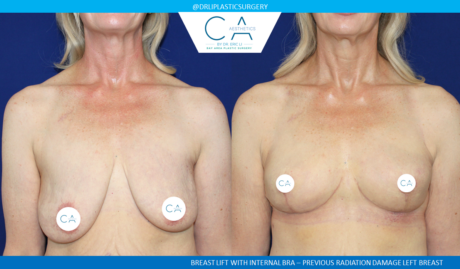 Breast Lift case #8436