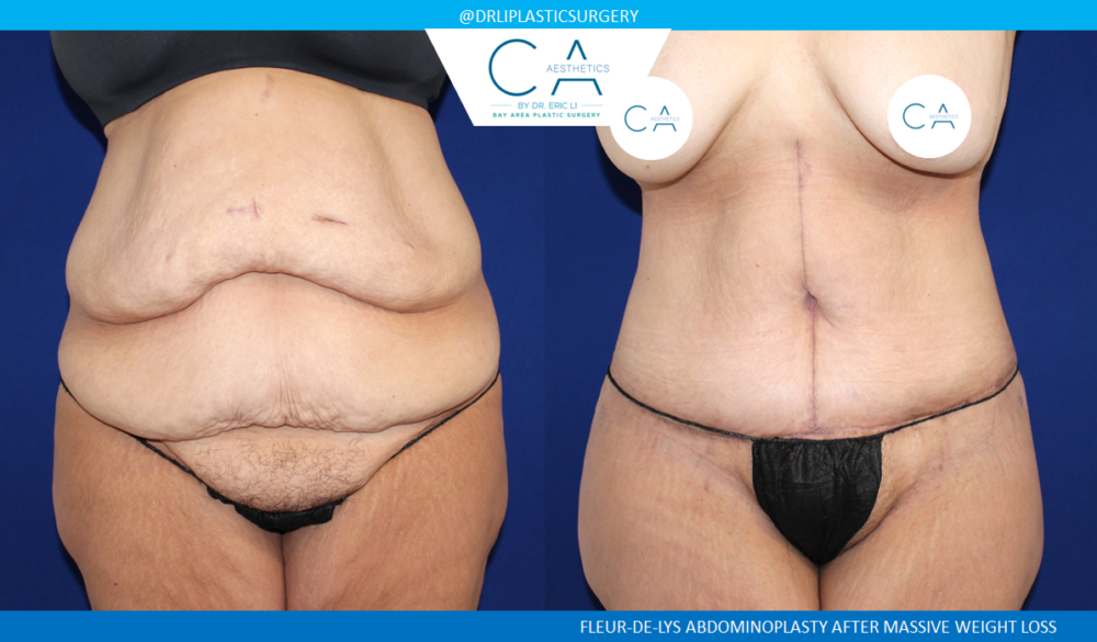 Tummy Tuck case #8495